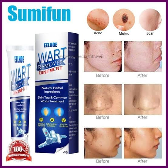 Wart Remover Ointment 20gm