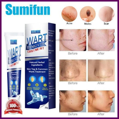 Wart Remover Ointment 20gm